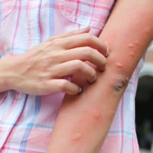 girl itching mosquito bites on her arm